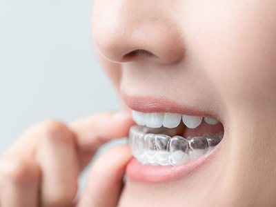Female holding her Invisalign aligner in preparation for putting it in