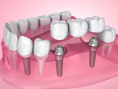 Dental implants with bridge and crown