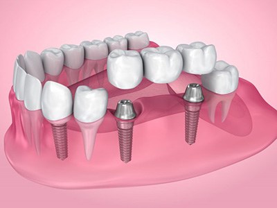 Exploded illustration of dental implants with bridge