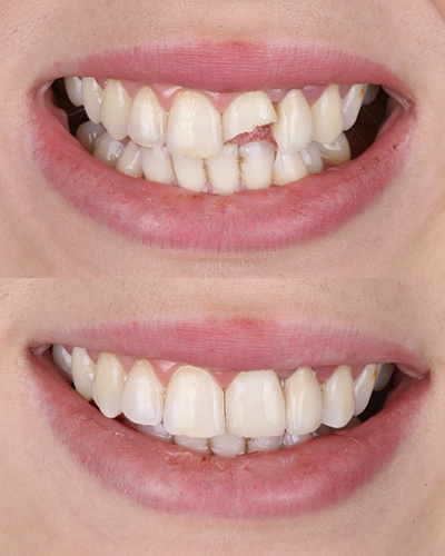 A smile before and after cosmetic dental bonding