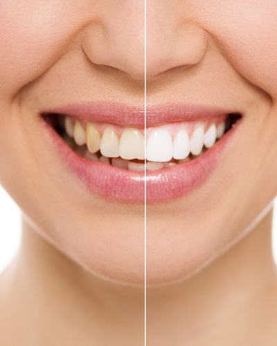 Patient in Mississauga smiling after teeth whitening