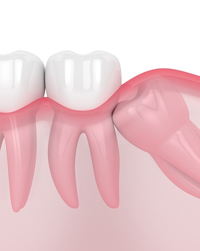 Illustration of molar growing in sideways