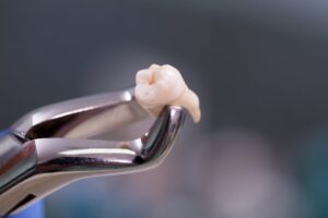 Close up of tooth that's been extracted.