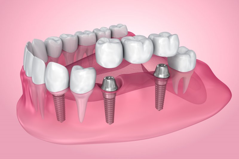 Illustration of dental implants with bridge and crown