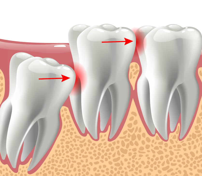 Illustrated cross section of wisdom teeth